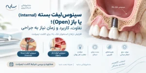 تفاوت سینوس باز و بسته لیفت