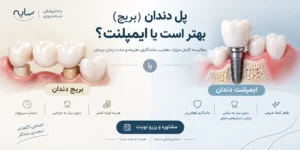 تفاوت پل دندان و ایمپلنت دندان